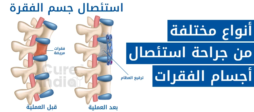 أنواع جراحة استئصال الجسم